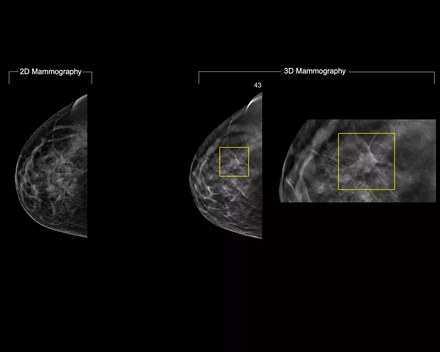 Breast screening image